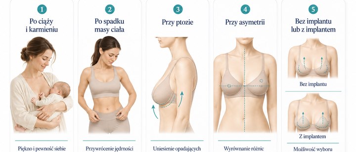 Efekty i trwałość podniesienia piersi